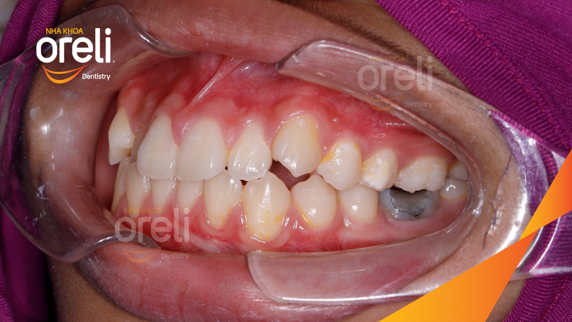 Trước điều trị: Chen chúc hai hàm, cắn ngược răng cửa bên tại Nha khoa Oreli