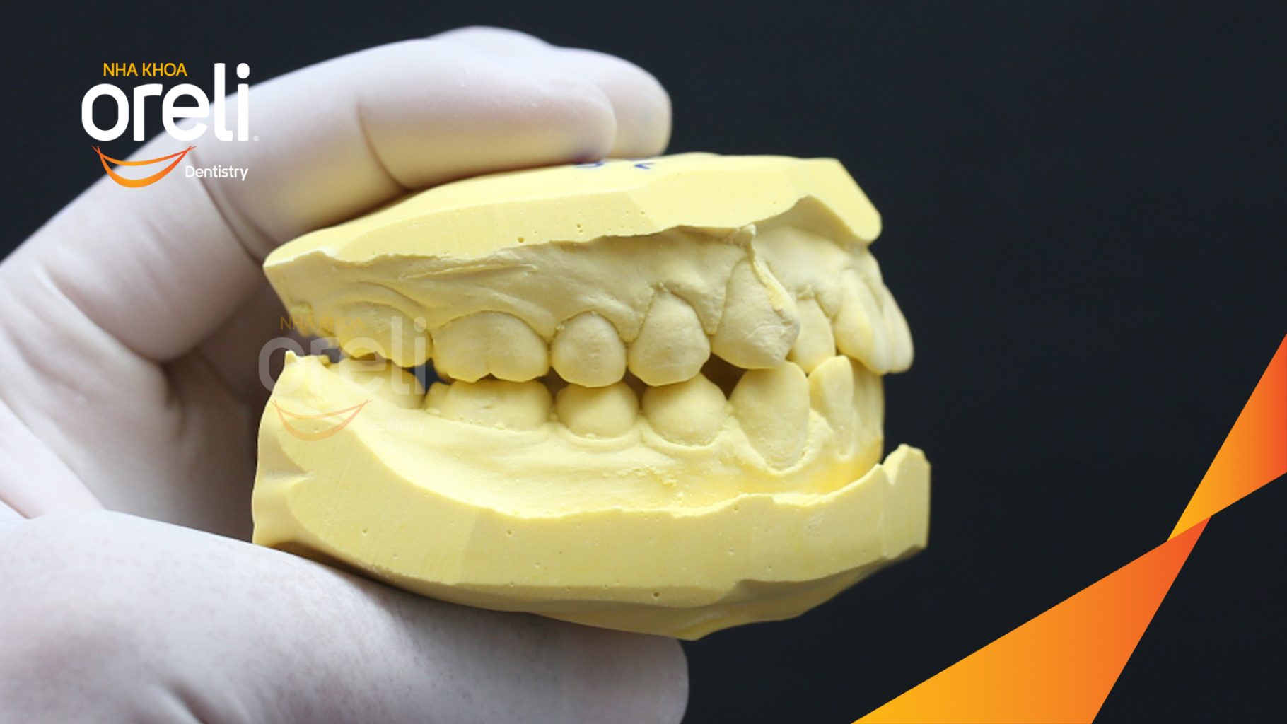 Quá trình Chỉnh nha mắc cài kim loại không nhổ răng trong 2 năm tại Nha khoa Oreli