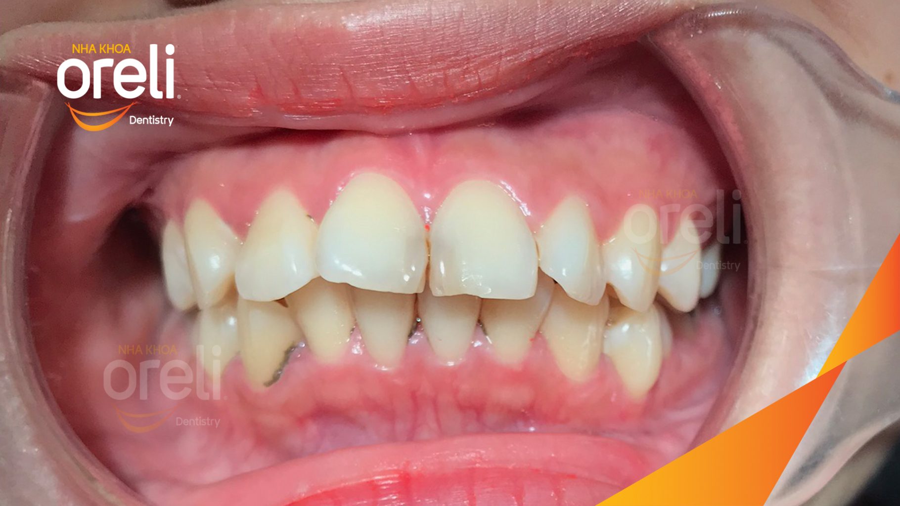 Trước điều trị: Nhô xương ổ hai hàm nặng tại Nha khoa Oreli
