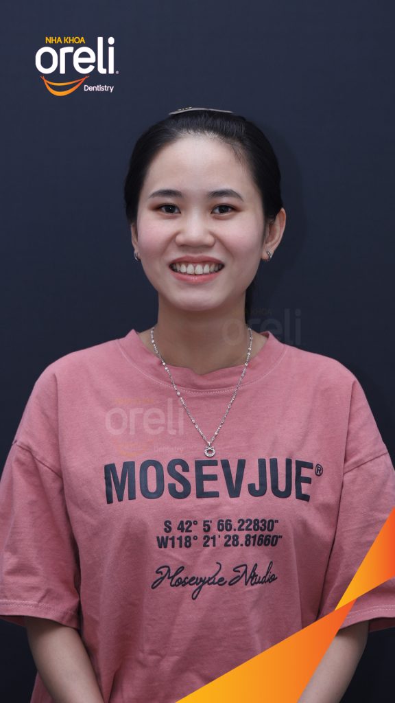 Nhô xương ổ hai hàm nặng trước khi điều trị tại Nha khoa Oreli