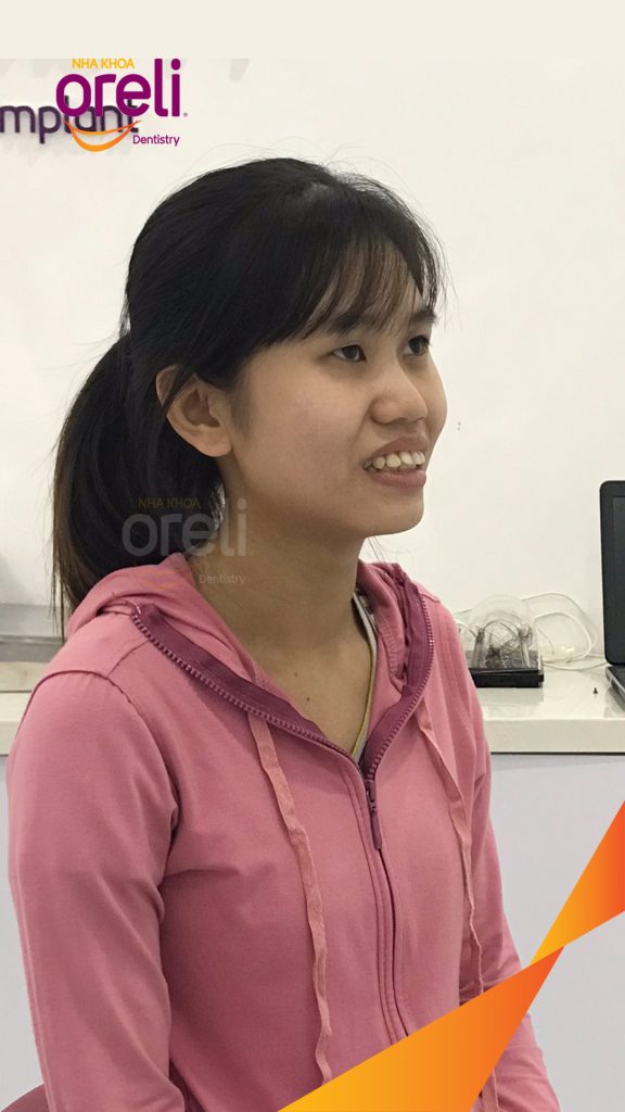 Quá trình Nhổ 4 răng số 4 niềng răng đóng khoảng trong 3 năm tại Nha khoa Oreli