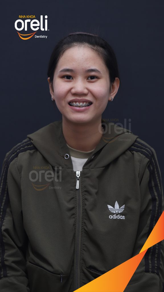 Kết quả đạt được sau 3 năm - Nụ cười thẩm mỹ hài hòa, khớp cắn đẹp tại Nha khoa Oreli