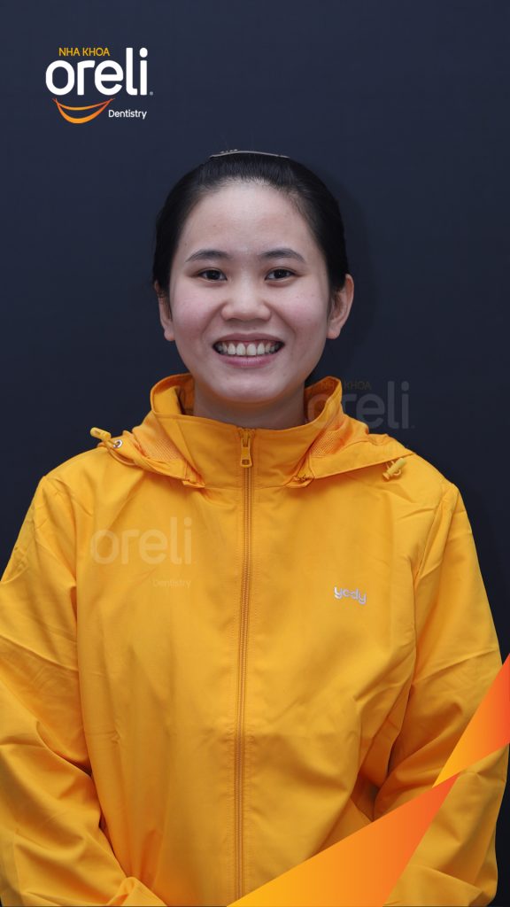Trước điều trị: Nhô xương ổ hai hàm nặng tại Nha khoa Oreli