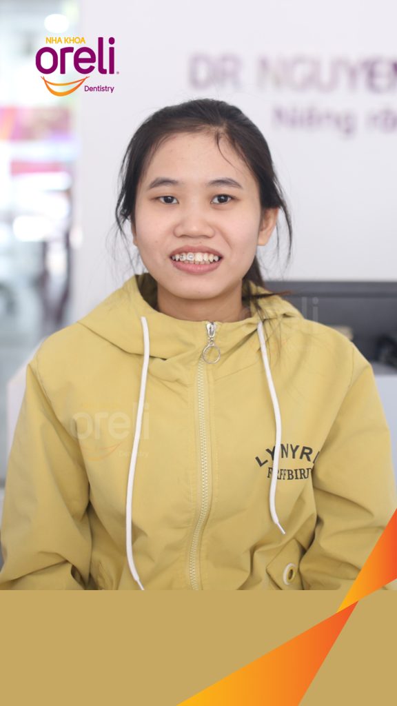 Thực hiện Nhổ 4 răng số 4 niềng răng đóng khoảng kéo dài 3 năm tại Nha khoa Oreli