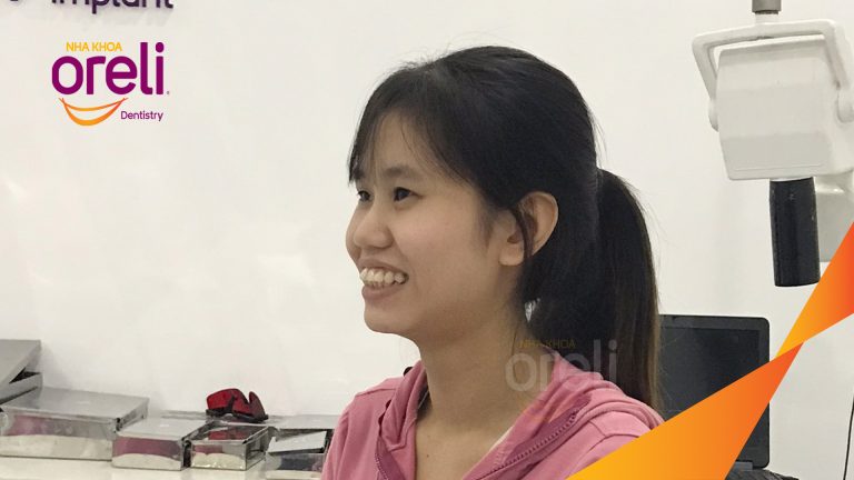 Ca niềng răng chỉnh hô có nhổ 4 răng 4 cho kết quả đẹp tại Nha Khoa Oreli