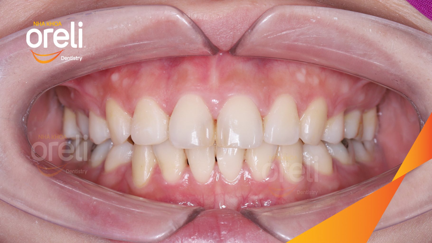 Nhô xương ổ hai hàm nặng trước khi điều trị tại Nha khoa Oreli