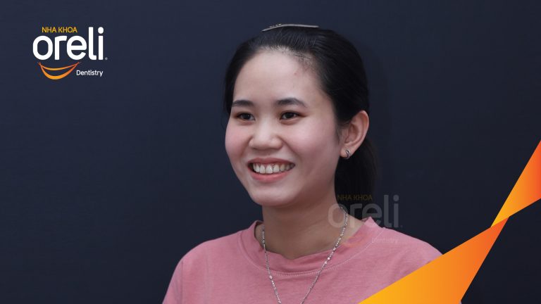 Ca niềng răng chỉnh hô có nhổ 4 răng 4 cho kết quả đẹp tại Nha Khoa Oreli