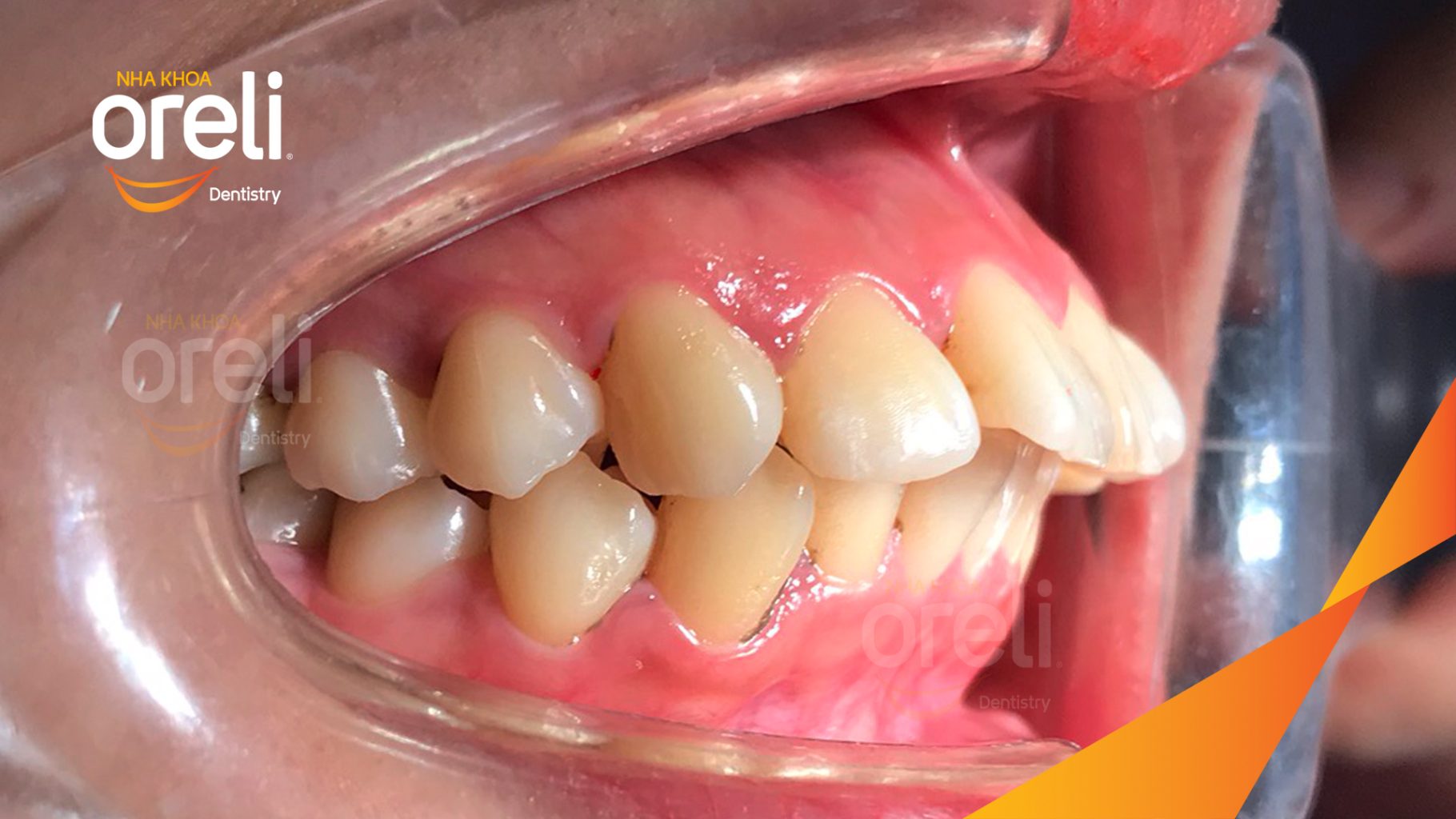 Quá trình Nhổ 4 răng số 4 niềng răng đóng khoảng trong 3 năm tại Nha khoa Oreli