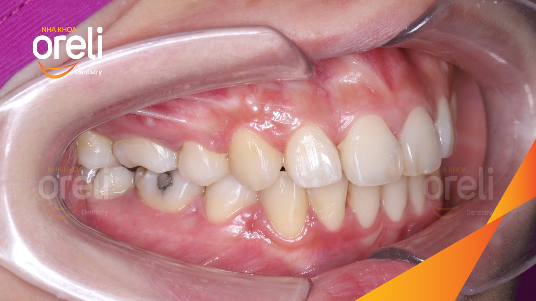 Thực hiện Nhổ 4 răng số 4 niềng răng đóng khoảng kéo dài 3 năm tại Nha khoa Oreli