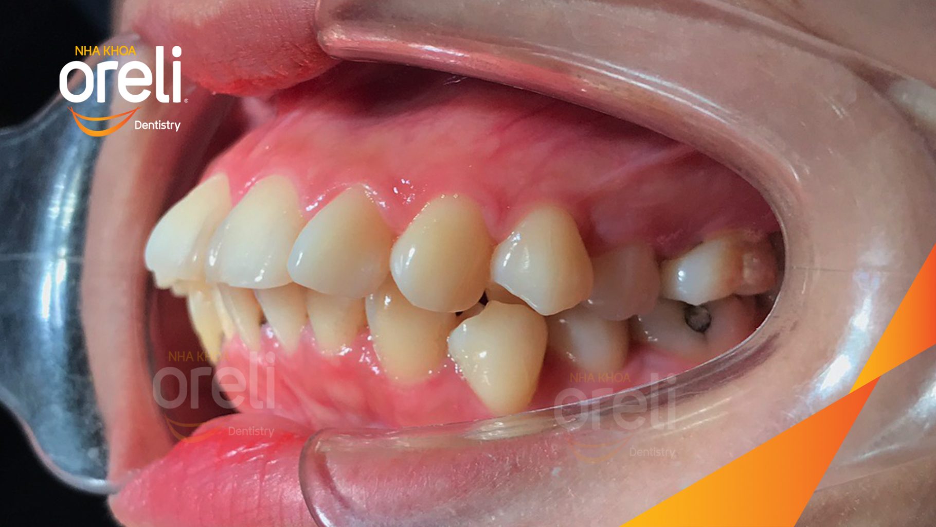 Kết quả sau 3 năm: Nụ cười thẩm mỹ hài hòa, khớp cắn đẹp tại Nha khoa Oreli
