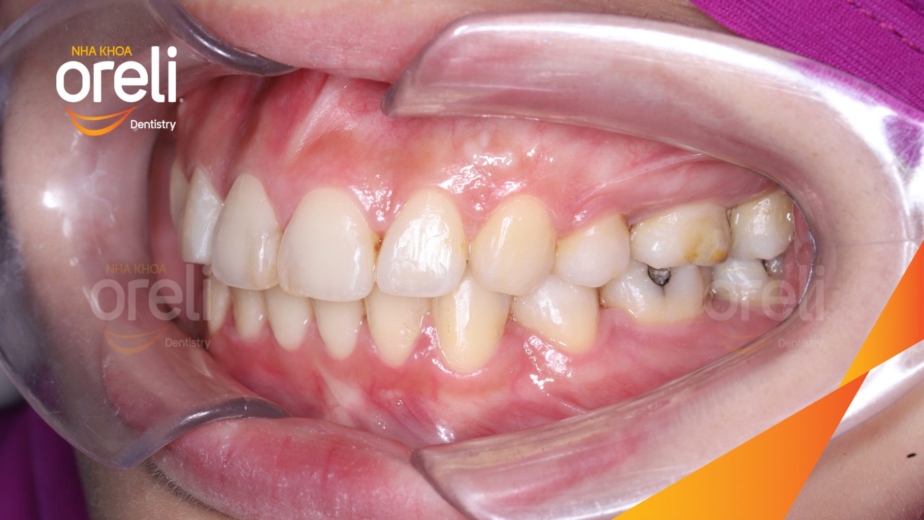 Kết quả đạt được sau 3 năm - Nụ cười thẩm mỹ hài hòa, khớp cắn đẹp tại Nha khoa Oreli