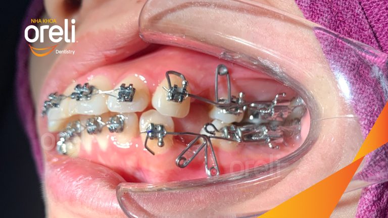 Ca niềng răng chỉnh hô có nhổ 4 răng 4 cho kết quả đẹp tại Nha Khoa Oreli
