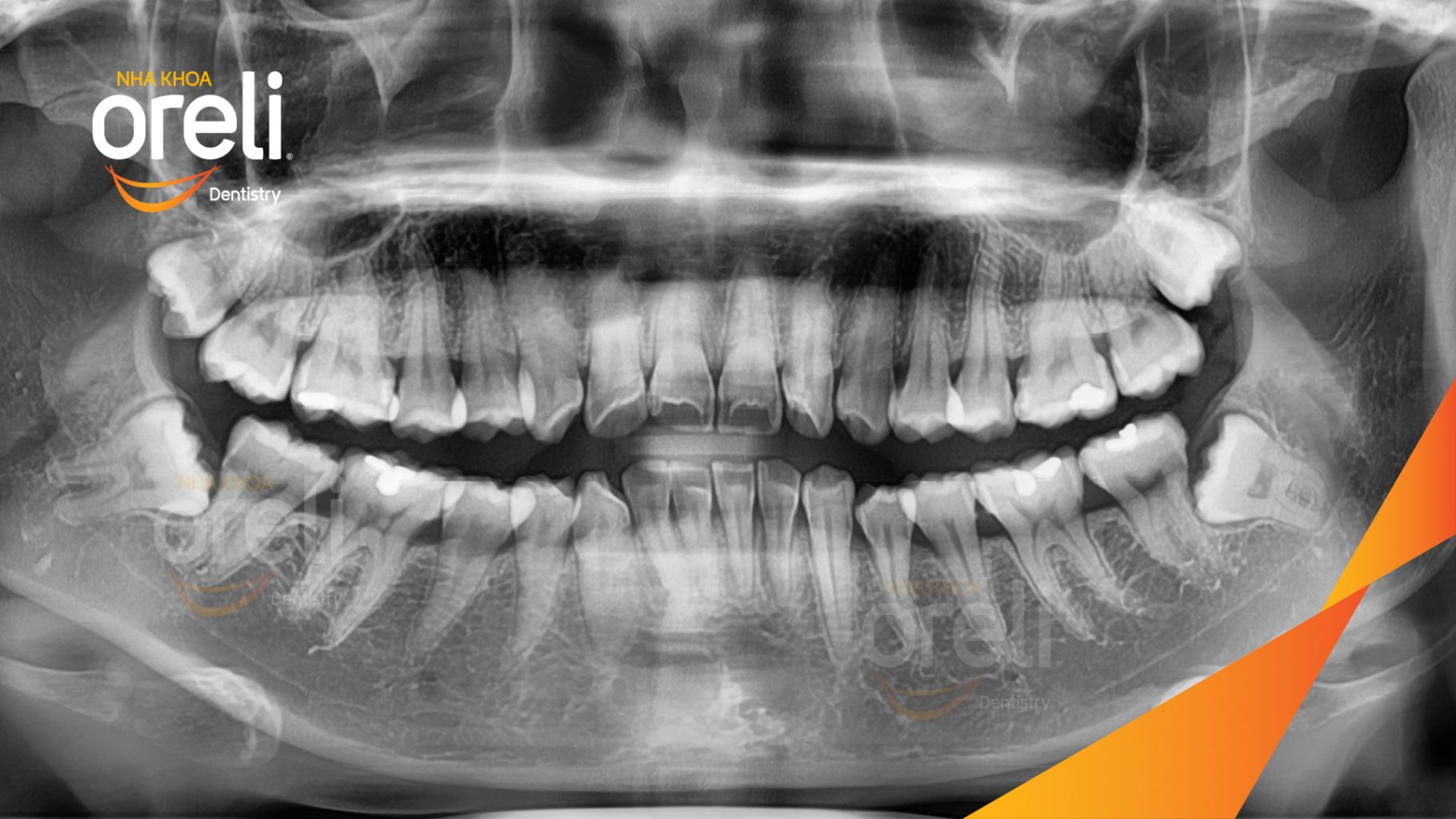 Nhô xương ổ hai hàm nặng trước khi điều trị tại Nha khoa Oreli