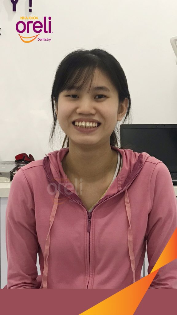Quá trình Nhổ 4 răng số 4 niềng răng đóng khoảng trong 3 năm tại Nha khoa Oreli
