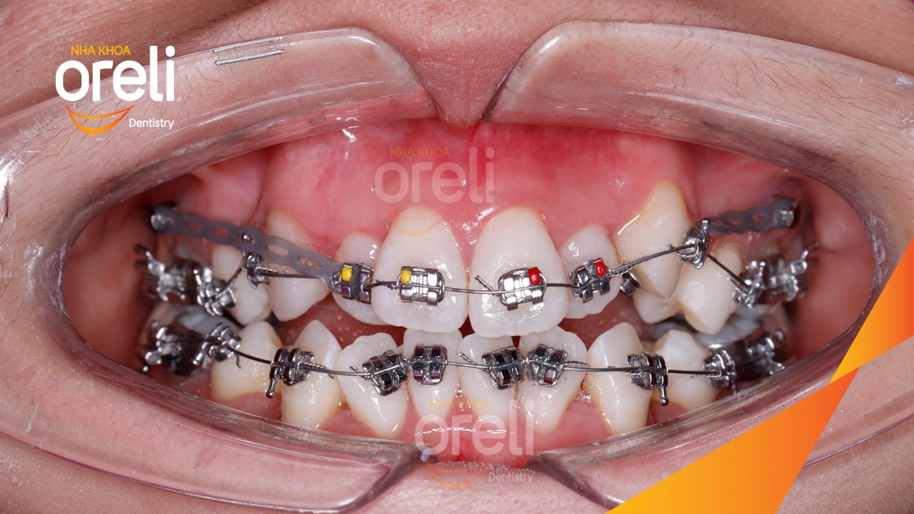 Quá trình Nhổ 4 răng 4 chỉnh khớp cắn và làm đều răng trong 3 năm tại Nha khoa Oreli