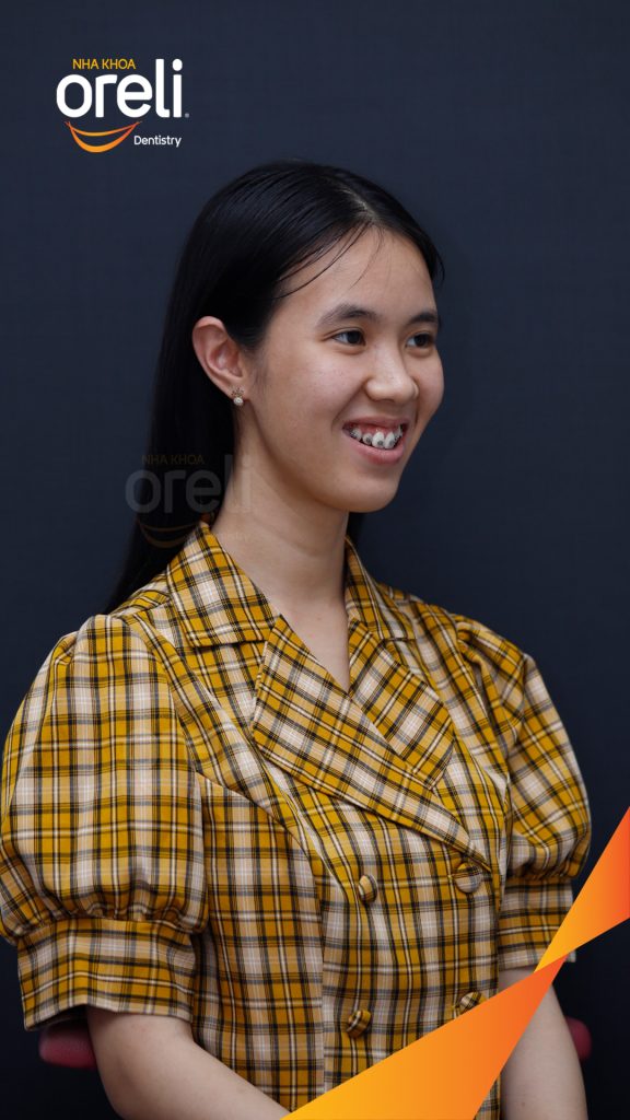 Trước điều trị: Răng chen chúc khấp khểnh, móm  tại Nha khoa Oreli