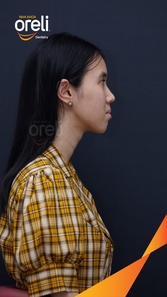 Kết quả sau 3 năm: Nụ cười hài hòa cân đối, khớp cắn đẹp tại Nha khoa Oreli