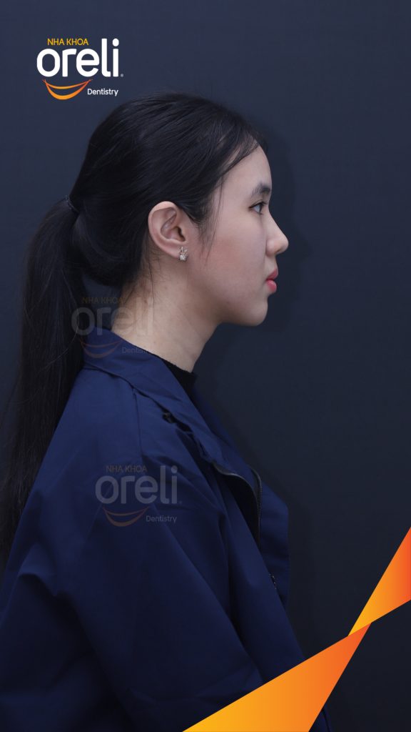 Kết quả đạt được sau 3 năm - Nụ cười hài hòa cân đối, khớp cắn đẹp tại Nha khoa Oreli