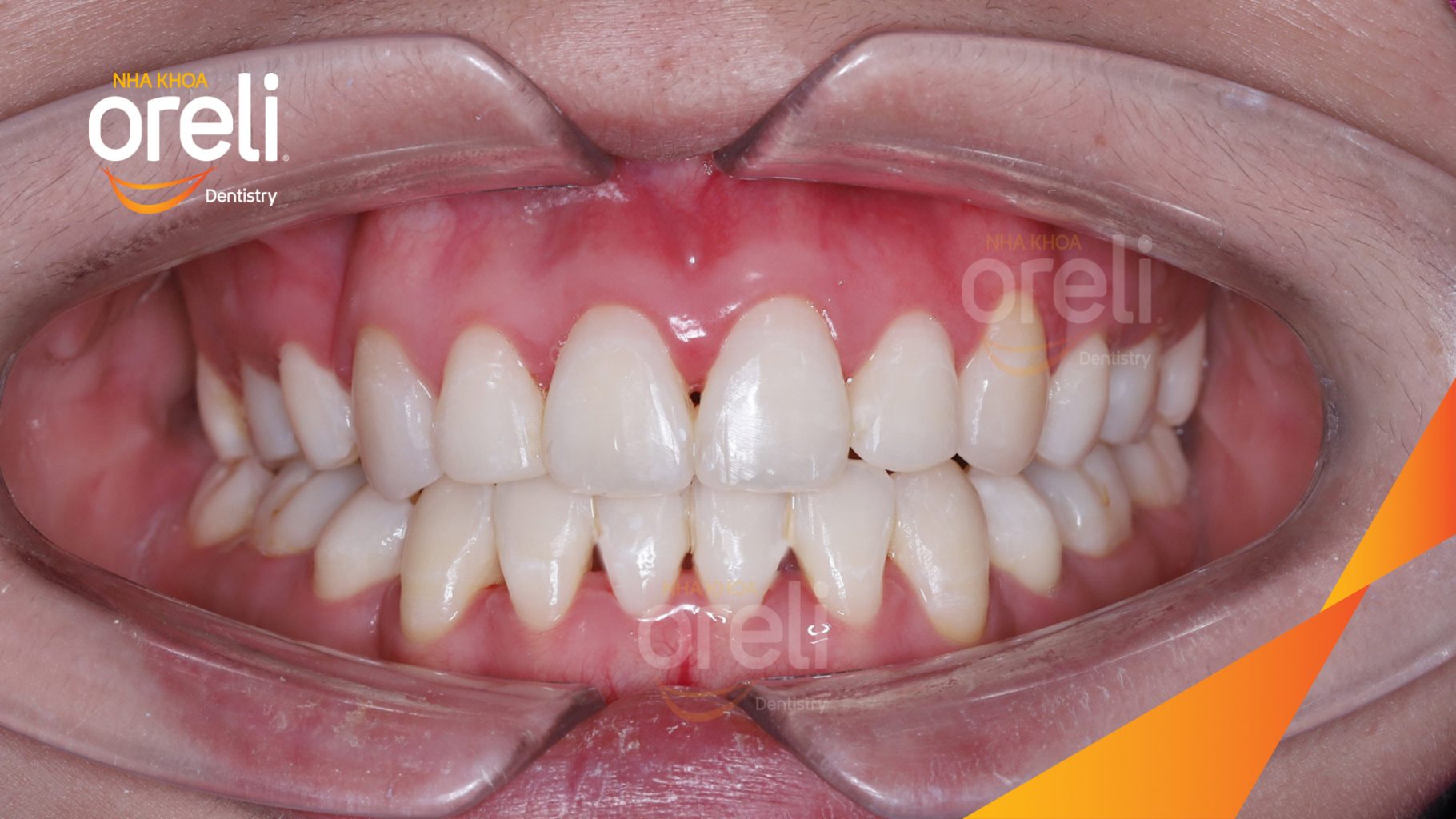 Thực hiện Nhổ 4 răng 4 chỉnh khớp cắn và làm đều răng kéo dài 3 năm tại Nha khoa Oreli