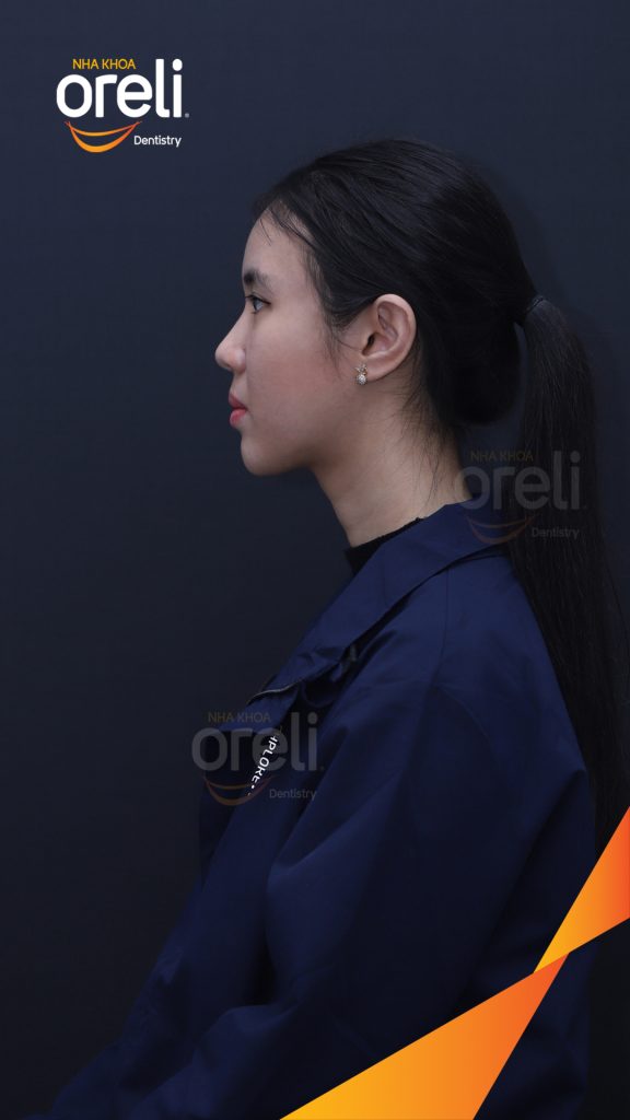 Thực hiện Nhổ 4 răng 4 chỉnh khớp cắn và làm đều răng kéo dài 3 năm tại Nha khoa Oreli