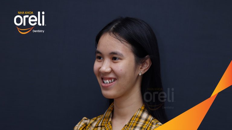 Ca niềng răng chen chúc sai khớp cắn hạng 3 cho nụ cười đẹp ở Nha Khoa Oreli