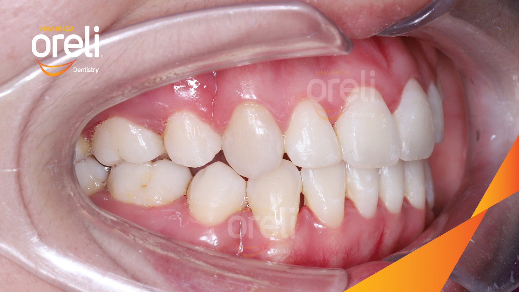 Kết quả đạt được sau 3 năm - Nụ cười hài hòa cân đối, khớp cắn đẹp tại Nha khoa Oreli