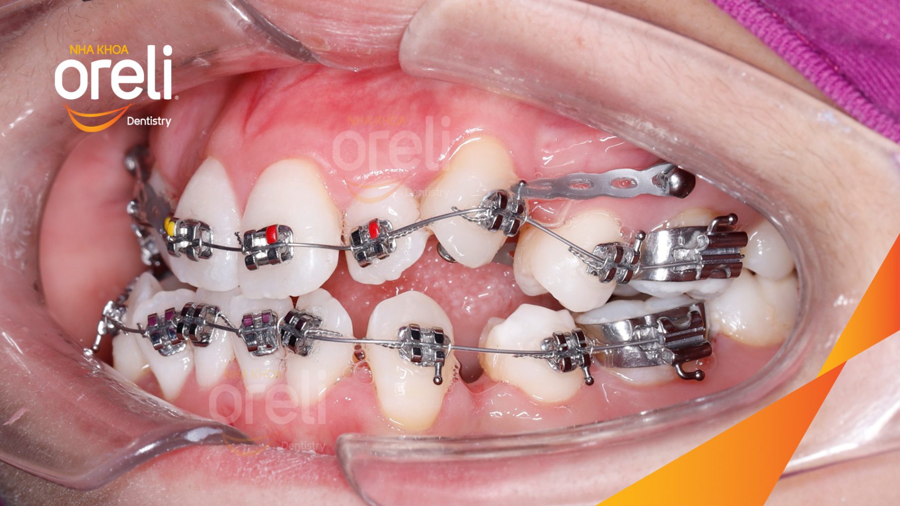 Trước điều trị: Răng chen chúc khấp khểnh, móm  tại Nha khoa Oreli