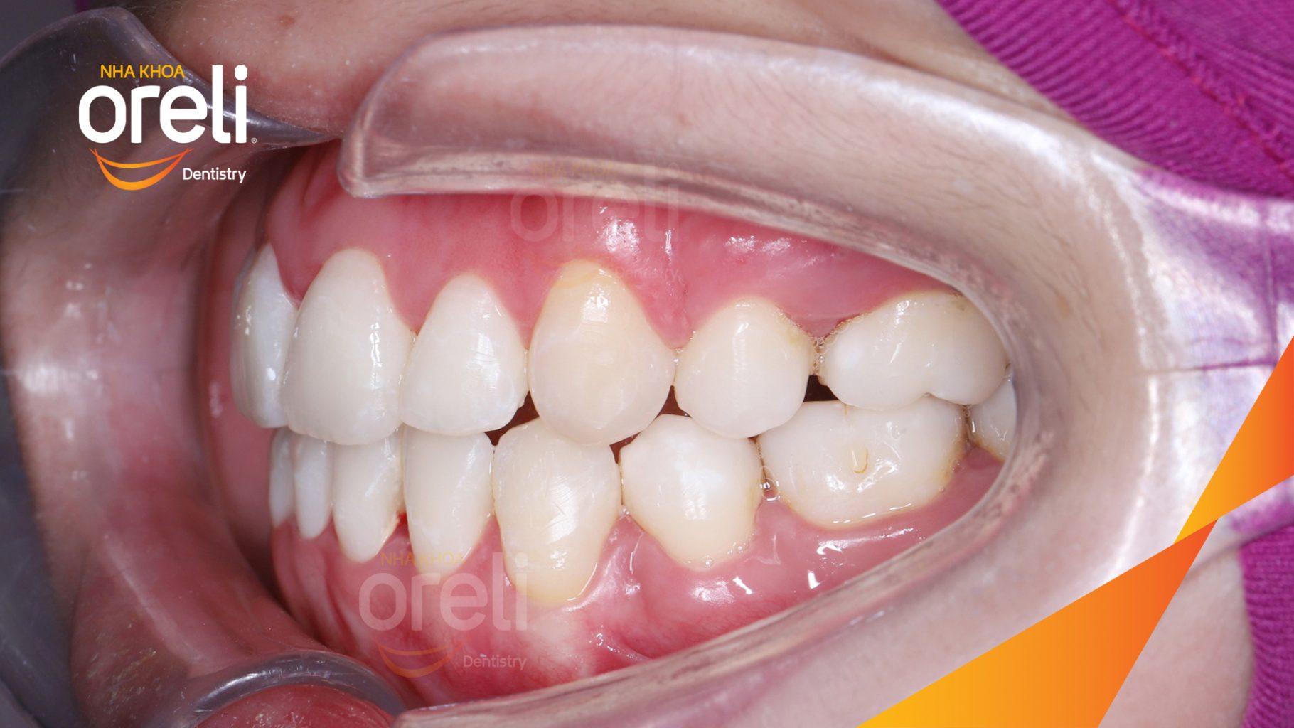 Răng chen chúc khấp khểnh, móm  trước khi điều trị tại Nha khoa Oreli
