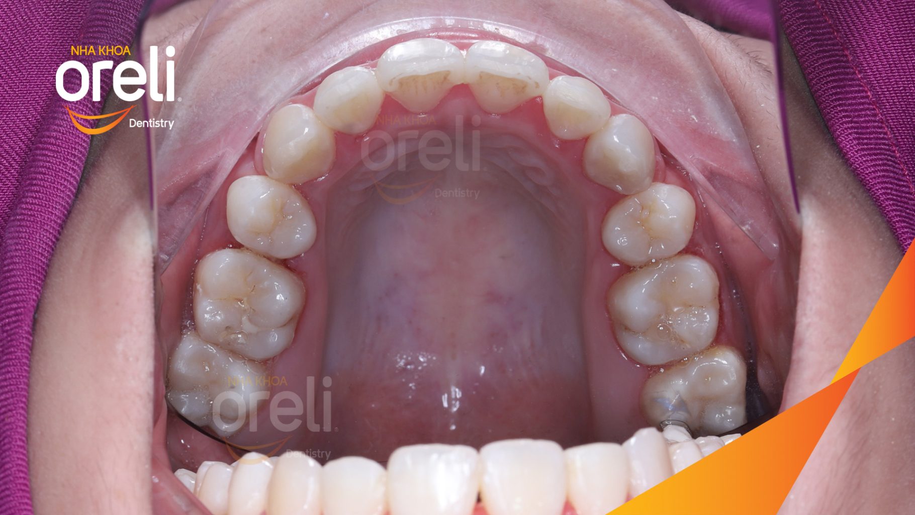 Quá trình Nhổ 4 răng 4 chỉnh khớp cắn và làm đều răng trong 3 năm tại Nha khoa Oreli