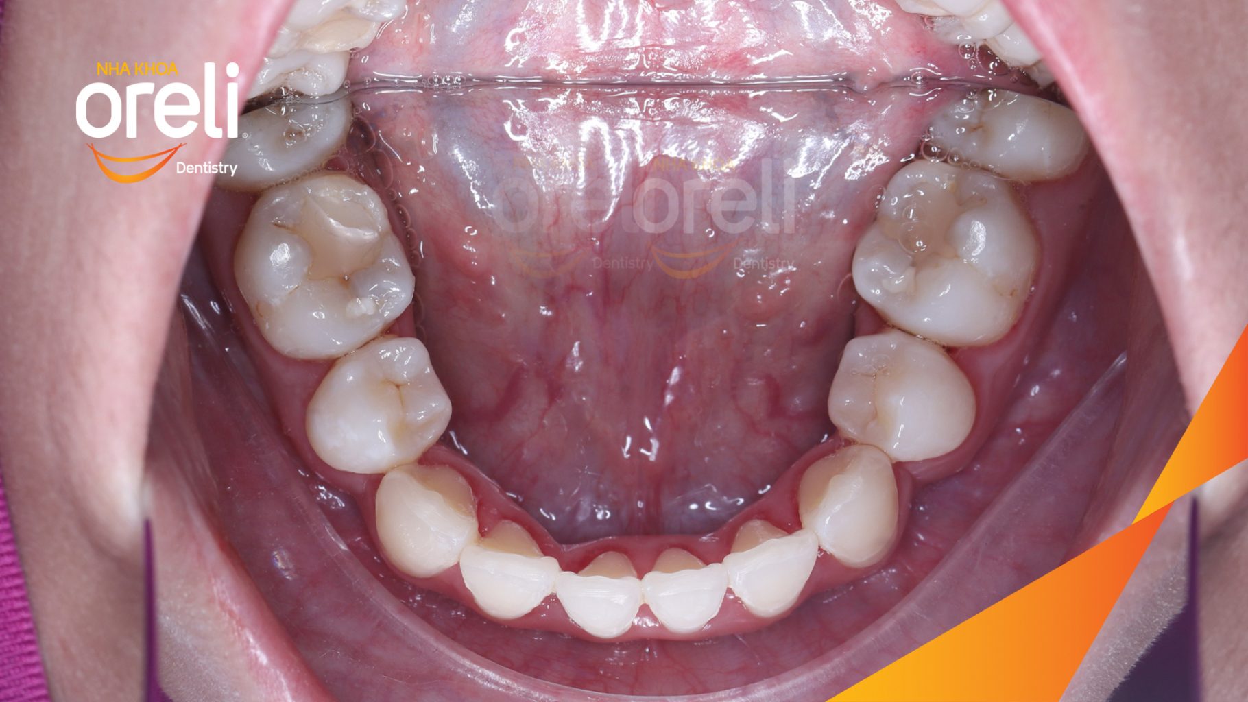 Thực hiện Nhổ 4 răng 4 chỉnh khớp cắn và làm đều răng kéo dài 3 năm tại Nha khoa Oreli
