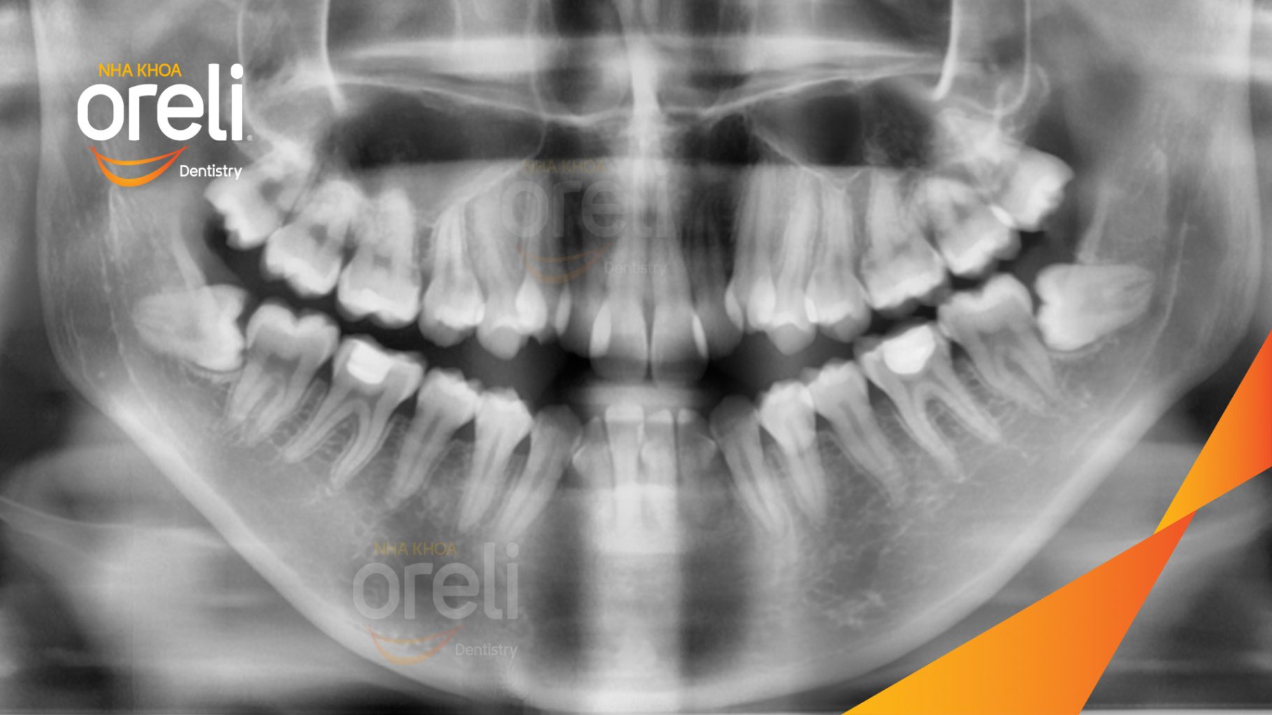 Trước điều trị: Răng chen chúc khấp khểnh, móm  tại Nha khoa Oreli