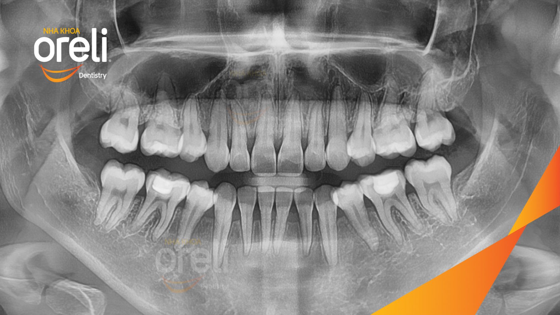Răng chen chúc khấp khểnh, móm  trước khi điều trị tại Nha khoa Oreli