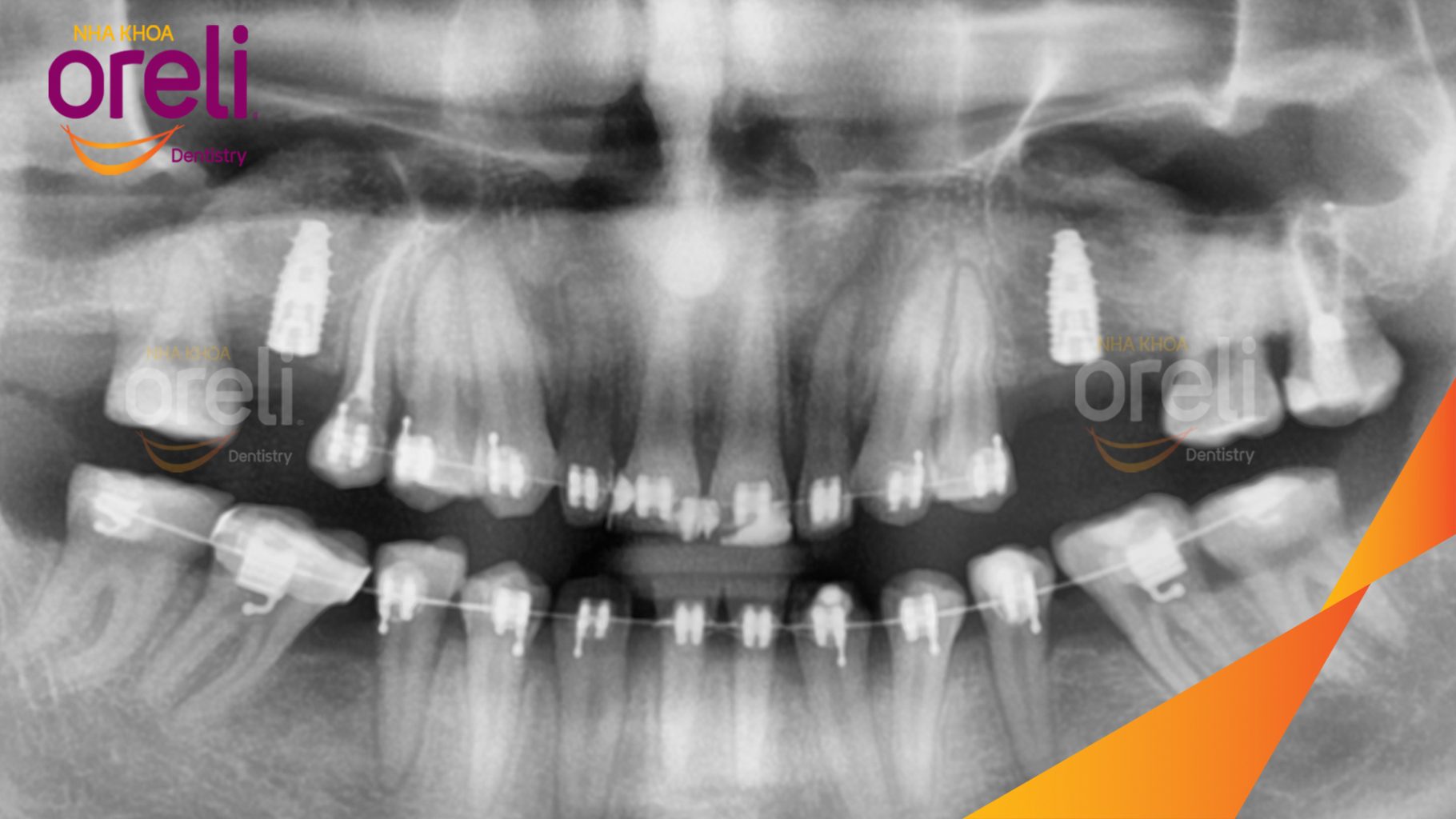 Mất răng hàm trên, xương hàm tiêu nhiều, chiều cao xương không đủ để đặt Implant trước khi điều trị tại Oreli