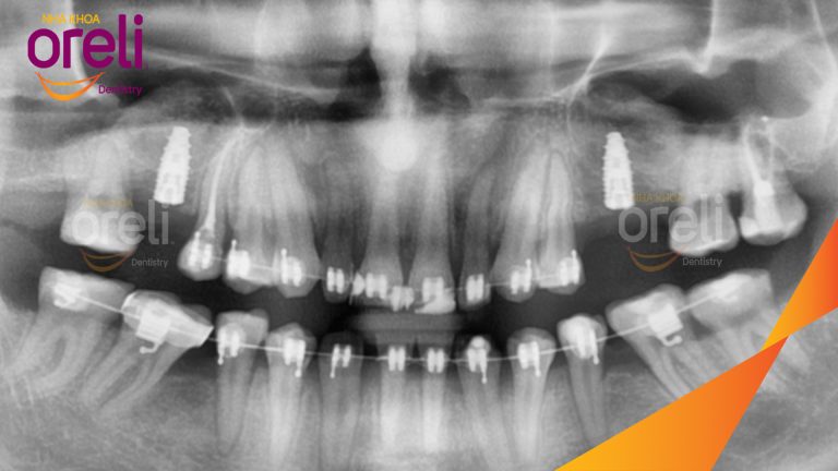 Ca Cấy Implant Kết Hợp Nâng Xoang Hở – Case thực tế tại Oreli