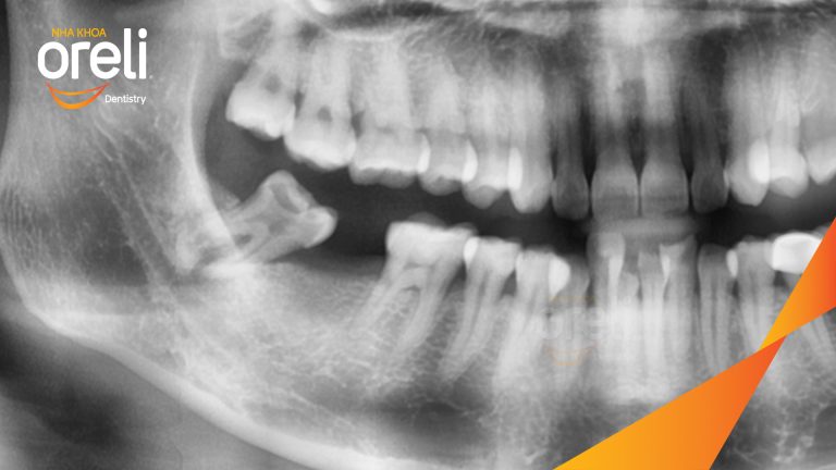 Ca Cấy Ghép Implant Phục Hồi Răng Tại Nha Khoa Oreli
