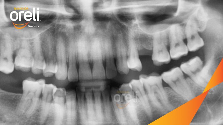 Ca Cấy Ghép Implant Phục Hồi Răng Tại Nha Khoa Oreli