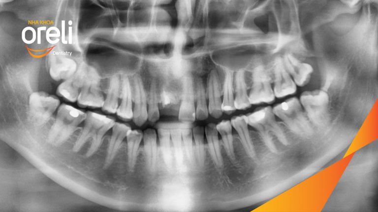 Cấy Ghép Implant Phục Hồi Răng Tại Nha Khoa Oreli