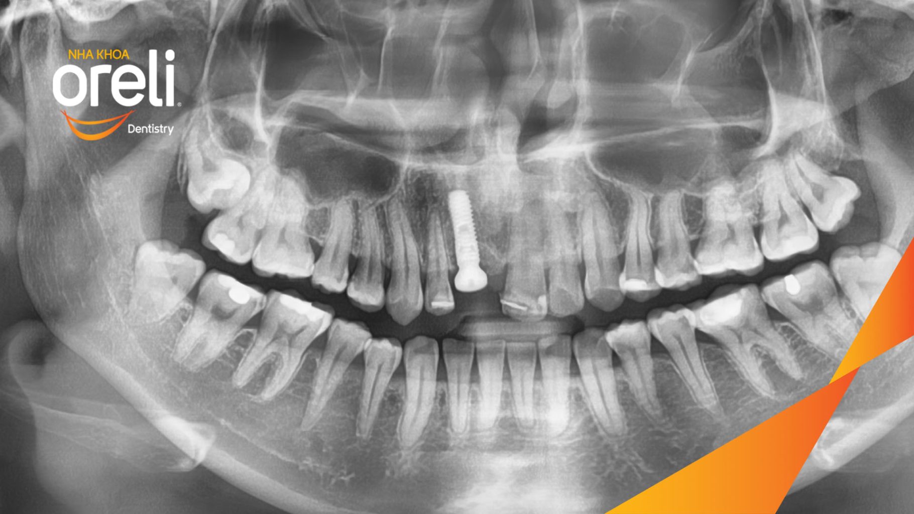  Mất răng hàm trên trước khi điều trị tại Oreli