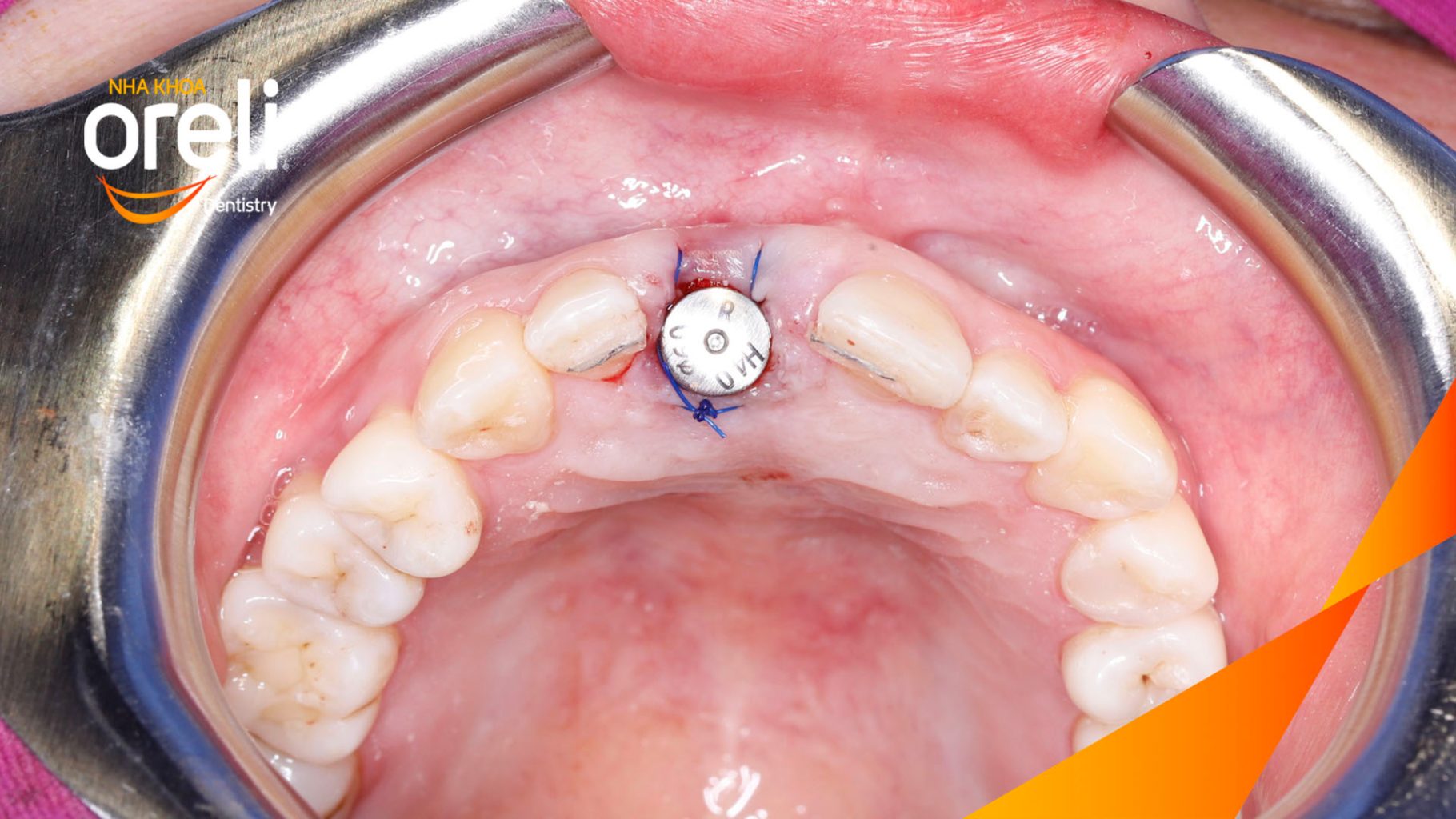 Kết quả đạt được sau 3 tháng - Phục hồi răng mất - ăn nhai chắc chắn và thẩm mỹ tự nhiên tại Oreli
