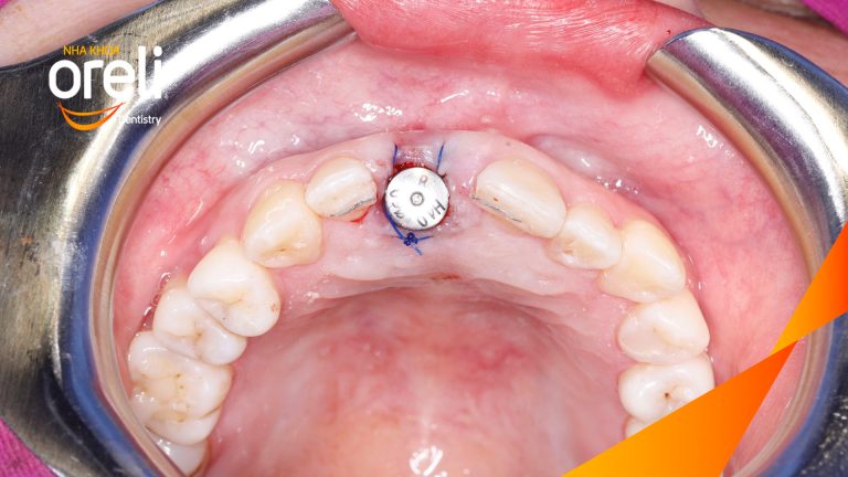 Cấy Ghép Implant Phục Hồi Răng Tại Nha Khoa Oreli