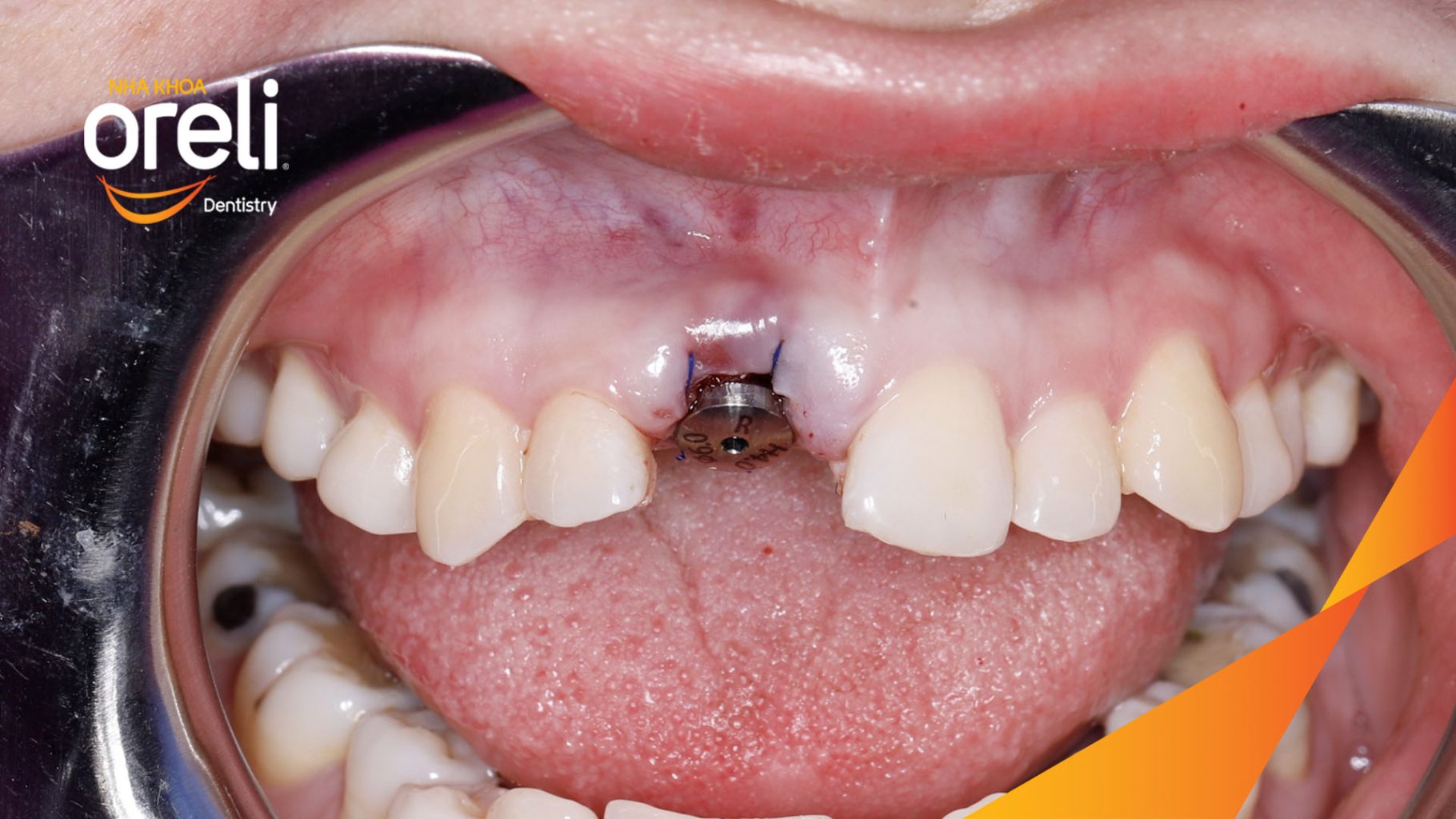 Kết quả sau 3 tháng: Phục hồi răng mất - ăn nhai chắc chắn và thẩm mỹ tự nhiên tại Oreli