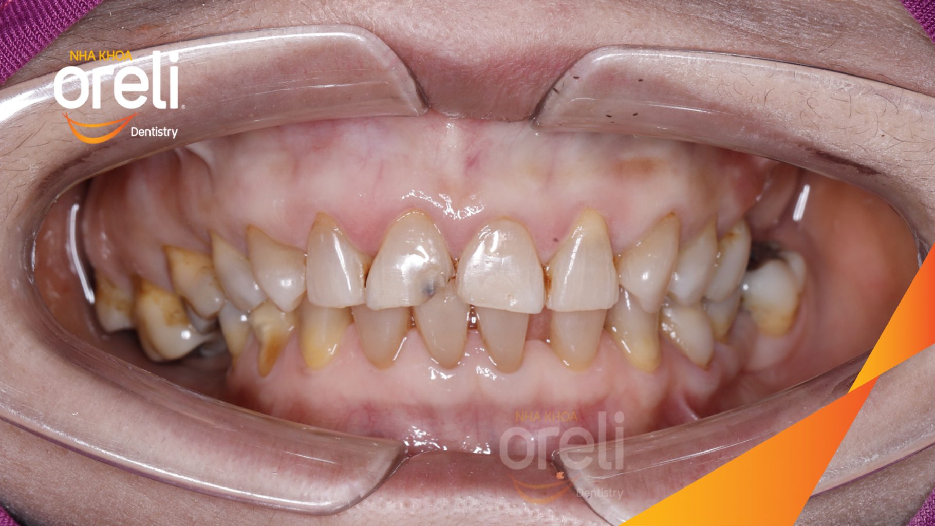 Kết quả sau : Màu răng trắng sáng tự nhiên, nụ cười hài hòa, trẻ trung và tự tin hơn. tại Oreli