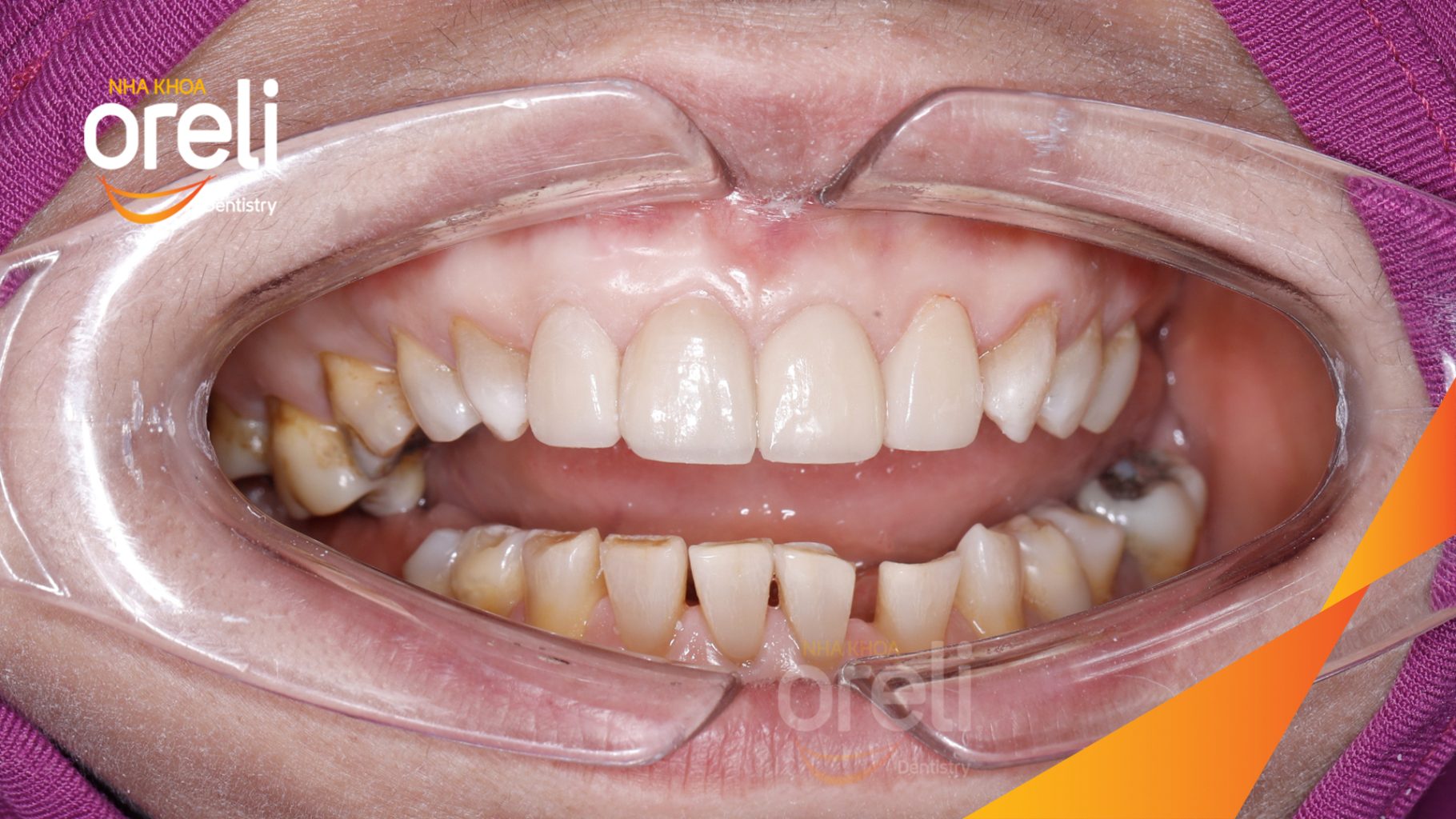 Kết quả đạt được sau  - Màu răng trắng sáng tự nhiên, nụ cười hài hòa, trẻ trung và tự tin hơn. tại Oreli