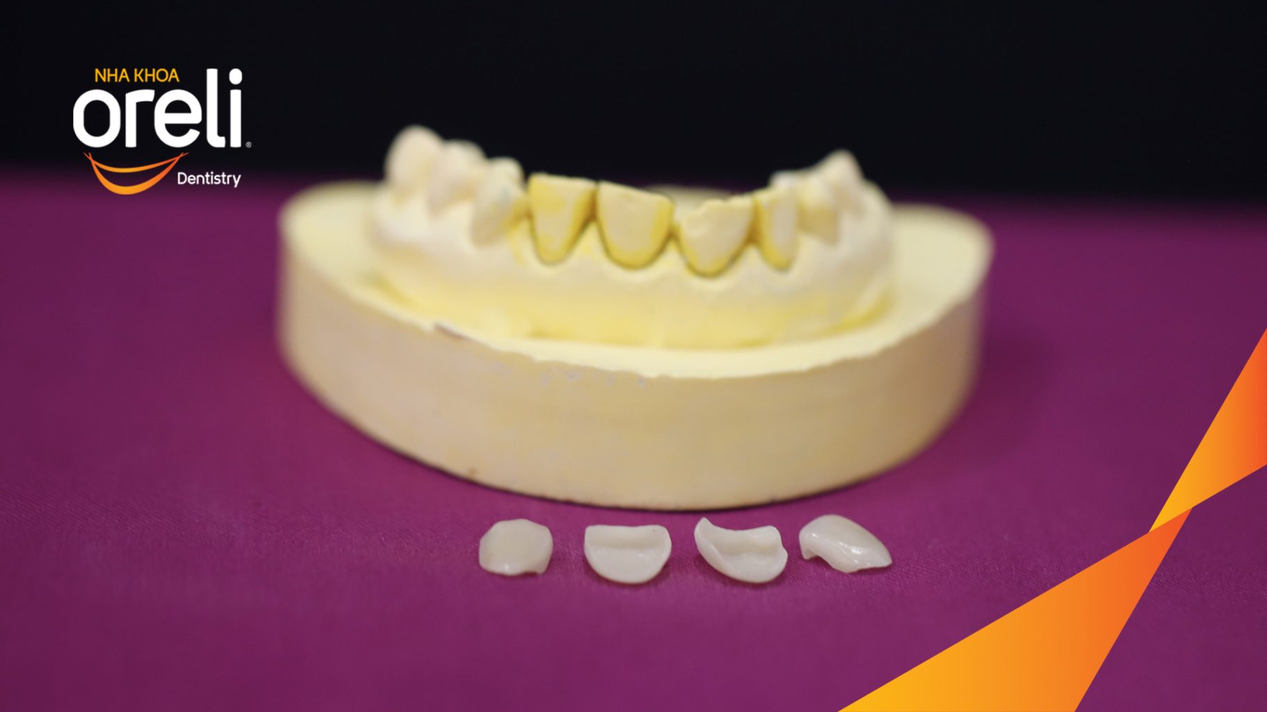 Quá trình Dán sứ Veneer cho nhóm răng cửa trong  tại Oreli