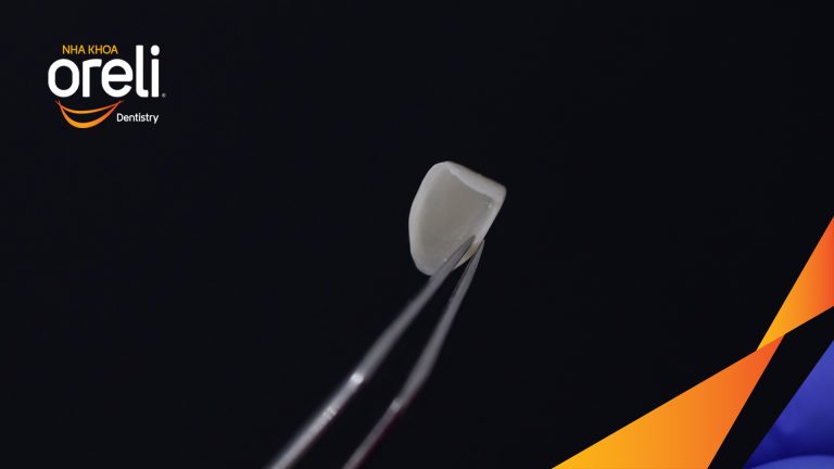 Dán sứ Veneer tại Buôn Ma Thuột | Nha khoa Oreli