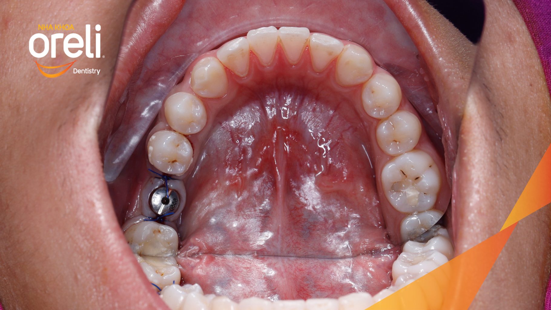 Quá trình Cấy ghép trụ Implant chính hãng vào vùng mất răng trong 3 tháng tại Oreli