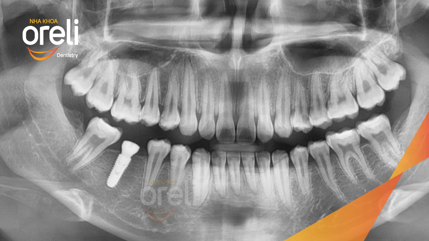 Mất răng hàm dưới trước khi điều trị tại Oreli