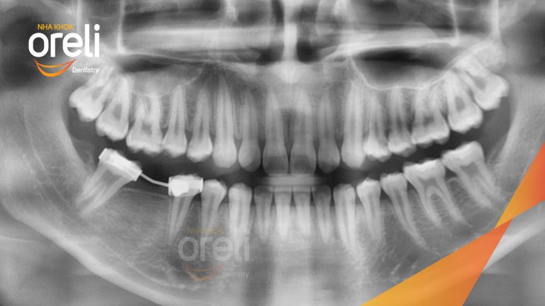 Ca Cấy Ghép Implant Phục Hồi Răng Tại Nha Khoa Oreli