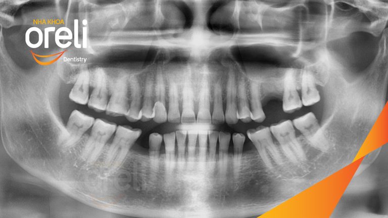 Ca Cấy Ghép Implant Hàm Dưới – Case thực tế tại Oreli