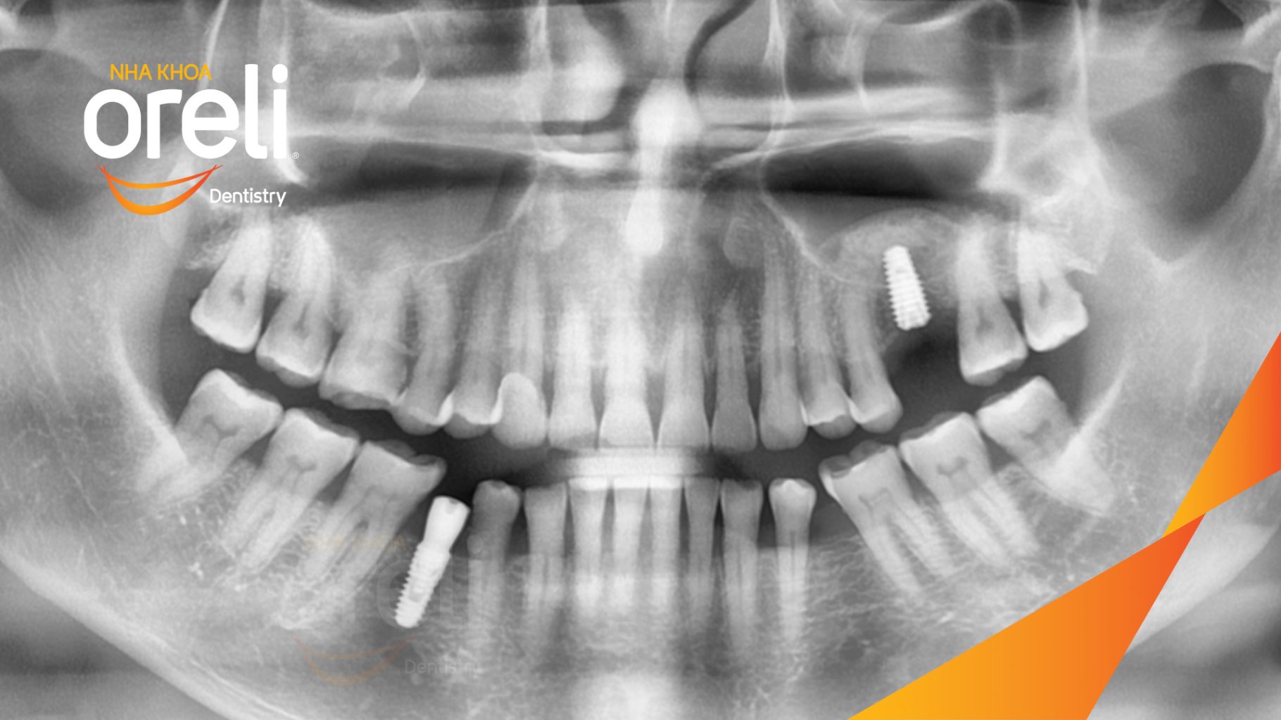 Mất răng hàm trên và dưới trước khi điều trị tại Oreli
